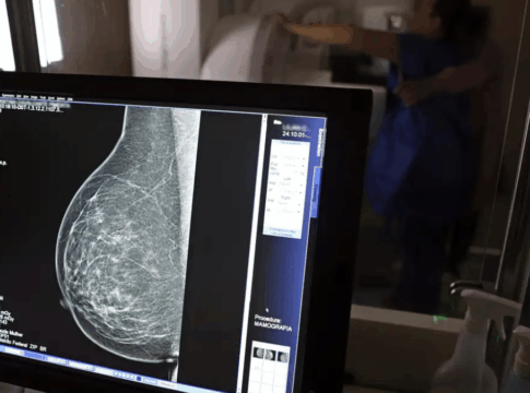 Falta de acesso a mamógrafos limita prevenção do câncer de mama