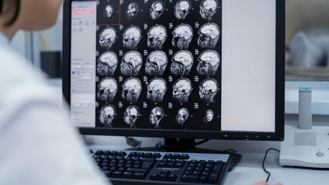 Médico observa exames de imagem do cérebro de um paciente