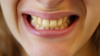 Em imagem ilustrativa, mulher mostra seus dentes amarelados