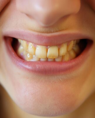 Em imagem ilustrativa, mulher mostra seus dentes amarelados