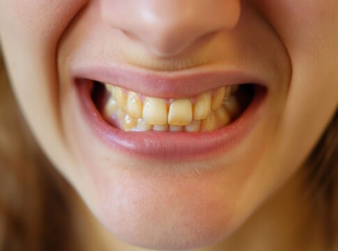Em imagem ilustrativa, mulher mostra seus dentes amarelados