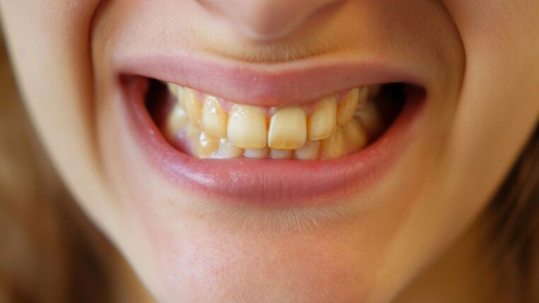 Em imagem ilustrativa, mulher mostra seus dentes amarelados