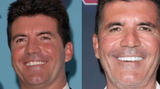 Montagem com duas fotos lado a lado mostrando o rosto de um homem adulto sorrindo; na imagem à esquerda, a pele parece mais lisa e jovem, enquanto na imagem à direita o homem aparenta estar mais velho, com linhas de expressão mais visíveis e dentes mais brancos.