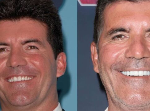Montagem com duas fotos lado a lado mostrando o rosto de um homem adulto sorrindo; na imagem à esquerda, a pele parece mais lisa e jovem, enquanto na imagem à direita o homem aparenta estar mais velho, com linhas de expressão mais visíveis e dentes mais brancos.