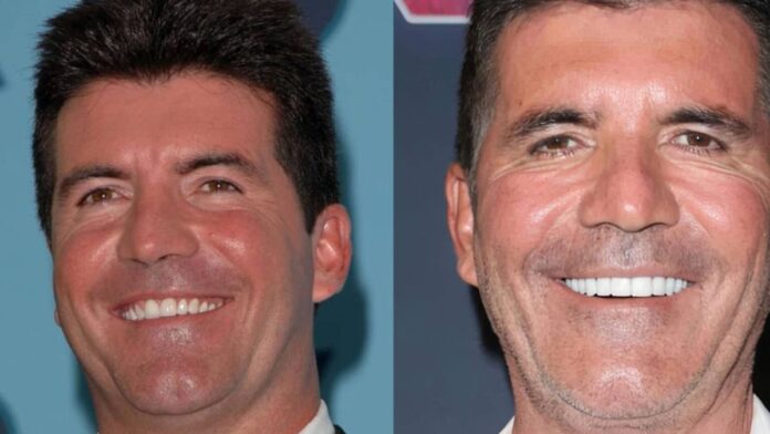 Montagem com duas fotos lado a lado mostrando o rosto de um homem adulto sorrindo; na imagem à esquerda, a pele parece mais lisa e jovem, enquanto na imagem à direita o homem aparenta estar mais velho, com linhas de expressão mais visíveis e dentes mais brancos.