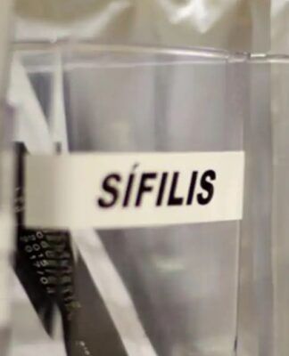 Sífilis continua em ritmo acelerado de crescimento no país